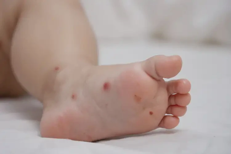 婴幼儿脚上偶尔长湿疹能治好吗(图4)