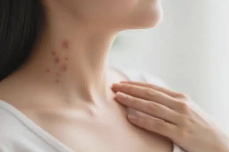 孕妇脖子上偶尔起湿疹能治好吗(图1)