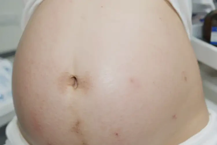 孕妇屁股上偶尔长湿疹能治好吗(图4)