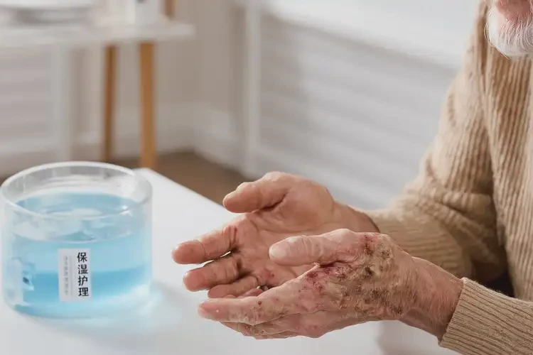 老年人手上容易起湿疹能治好吗(图2)
