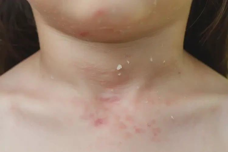 孩子脖子出湿疹能彻底自愈吗(图4)