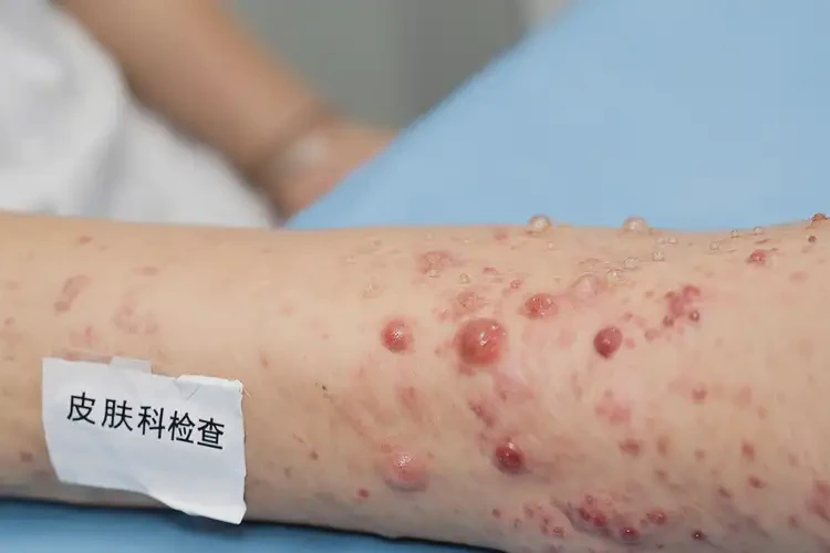 女人手臂容易长湿疹能够彻底治愈吗(图4)