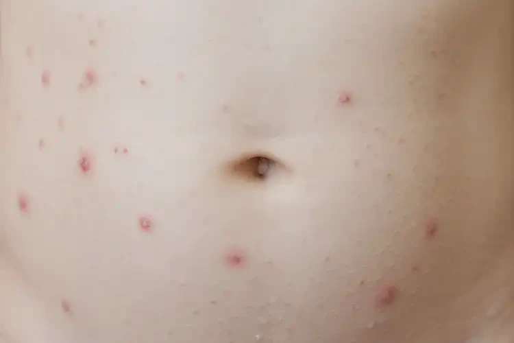 孩子肚子上长湿疹能治好吗(图4)