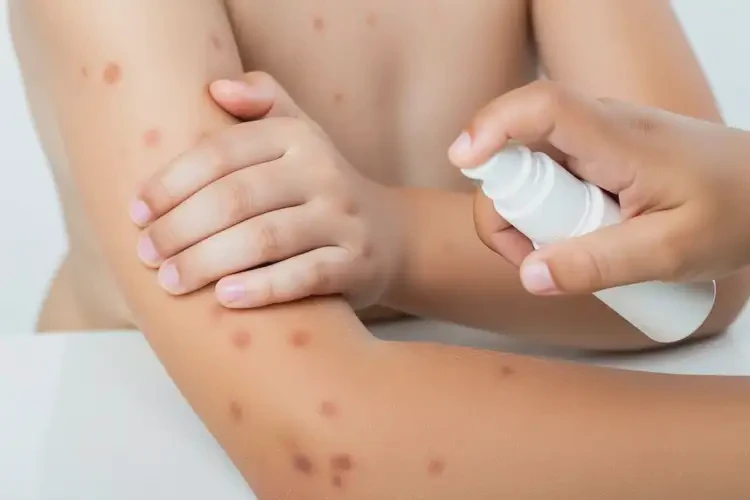 孩子四肢容易长湿疹能治好吗(图2)