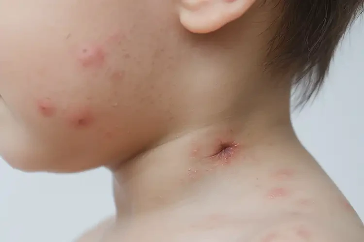 儿童脖子上有湿疹能治好吗(图4)