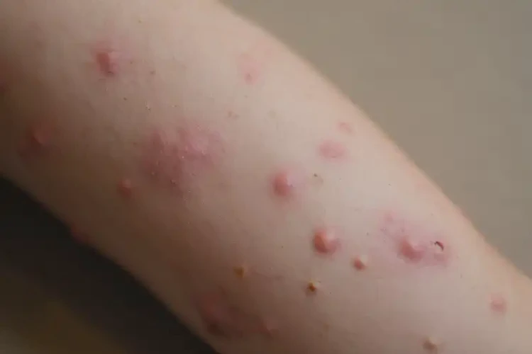 孩子手臂有湿疹能治好吗(图4)