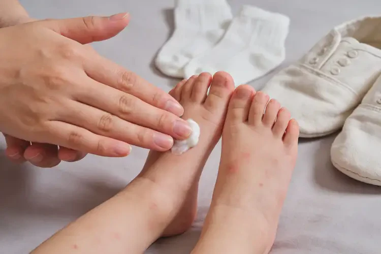 小孩脚上偶尔起湿疹不管它会自己自愈吗(图1)