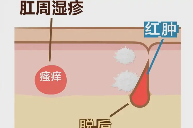 男性肛周容易起湿疹能治好吗(图4)