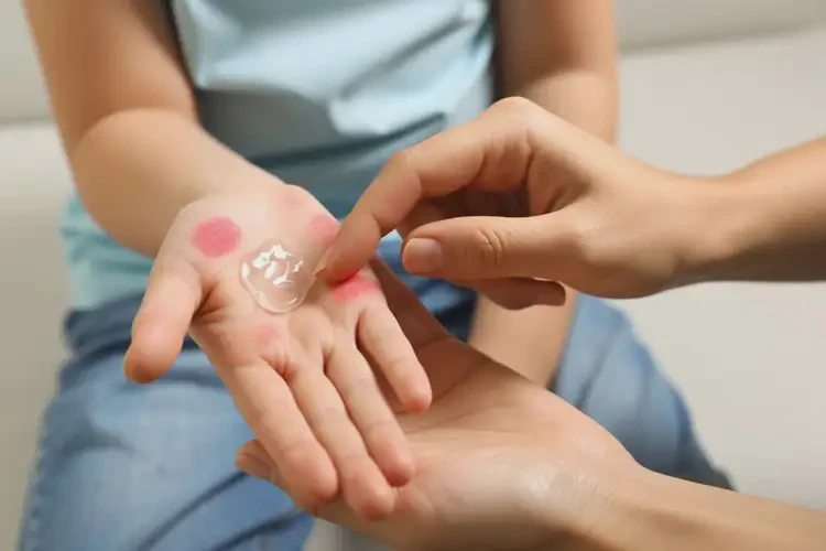 孩子四肢容易长湿疹能治好吗(图4)