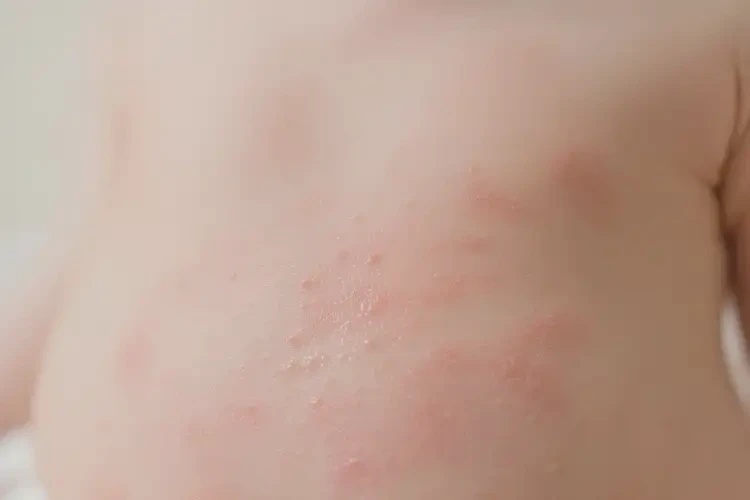 小儿肚子出湿疹能治好吗(图4)