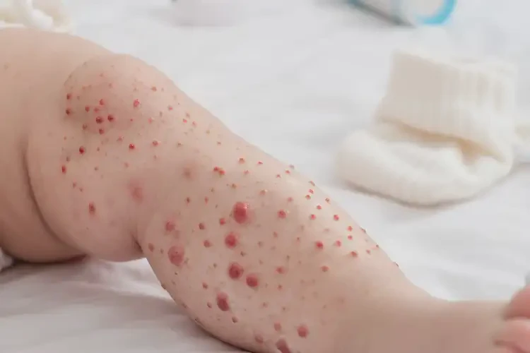 婴幼儿小腿上长湿疹能治好吗(图4)