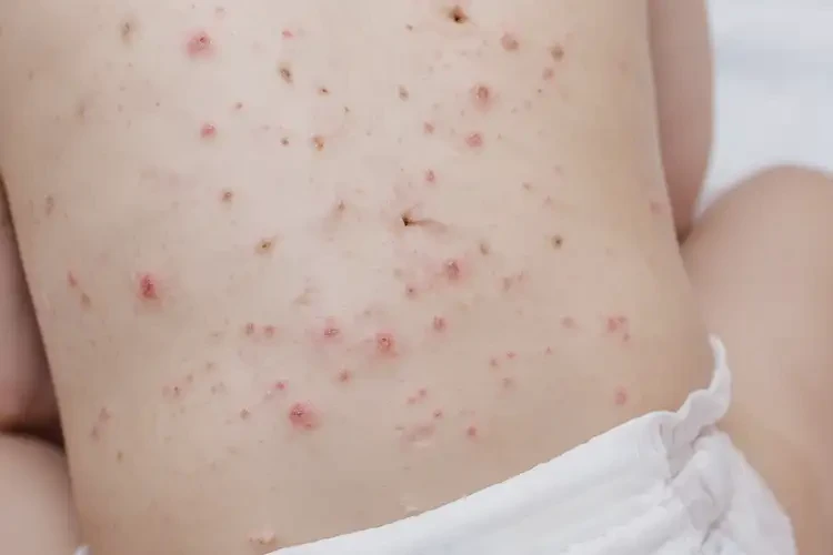 小孩屁股长湿疹不管它会自己好吗(图4)