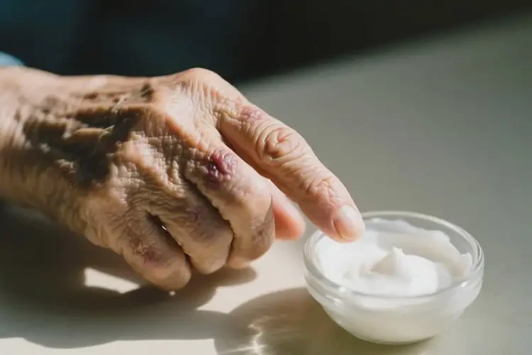 老人四肢出湿疹能治好吗(图2)