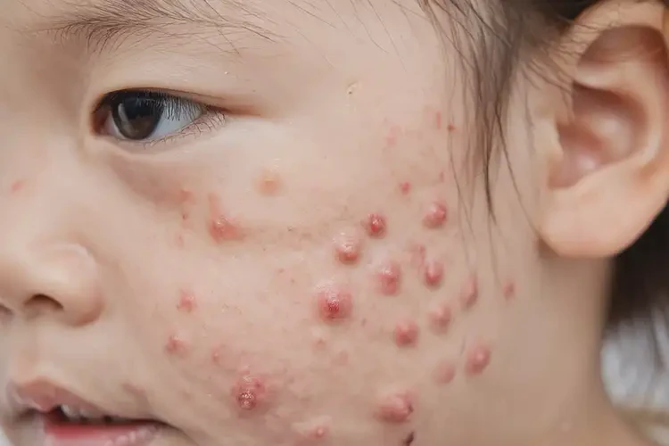 儿童面部起湿疹能治好吗(图2)