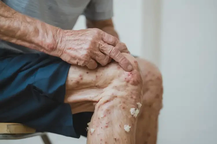 老年人小腿长湿疹不管它会自己痊愈吗(图4)