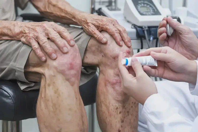 老人小腿上偶尔长湿疹能治好吗(图2)