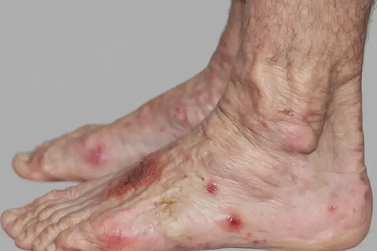 老年人脚上起湿疹能不能彻底自愈(图4)