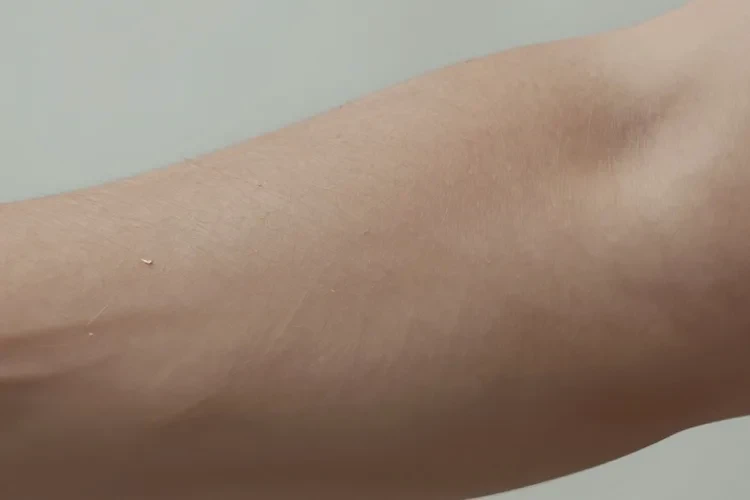 男人手臂长湿疹能治愈吗(图2)