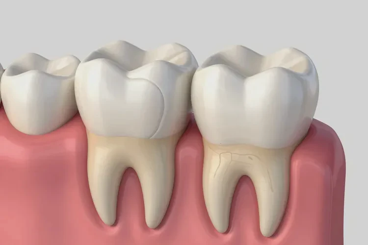 正畸牙齒松動(dòng)多少正常(圖2)