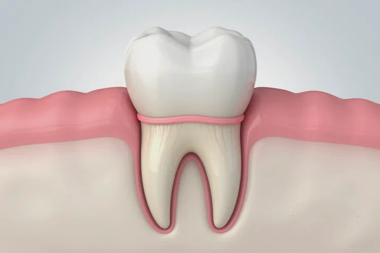 正畸牙齒移動原理(圖3)