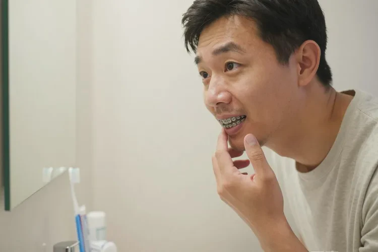 正畸牙齒的步驟(圖3)