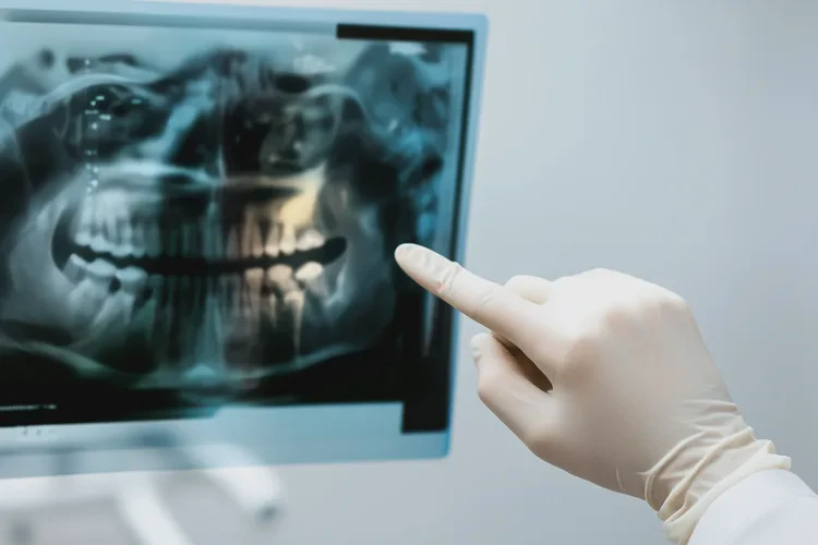 正畸時(shí)為什么牙齒松動(dòng)(圖3)